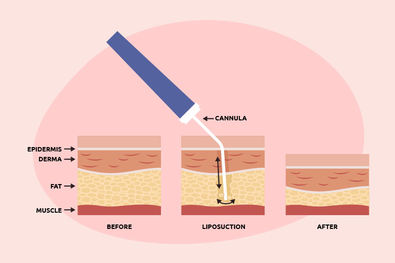 Liposuction informative diagram